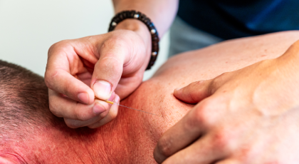 Dry needling